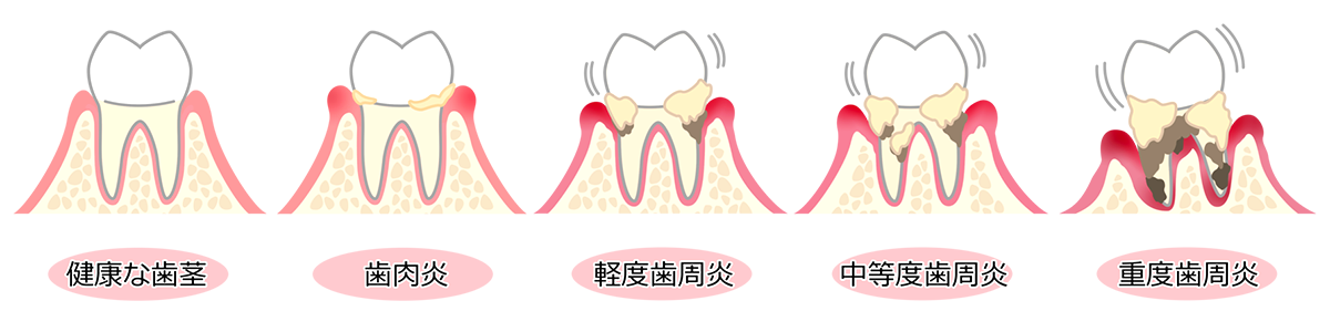 歯茎の進行度