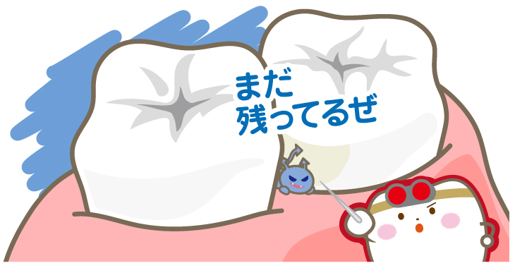 歯の間に残る汚れ