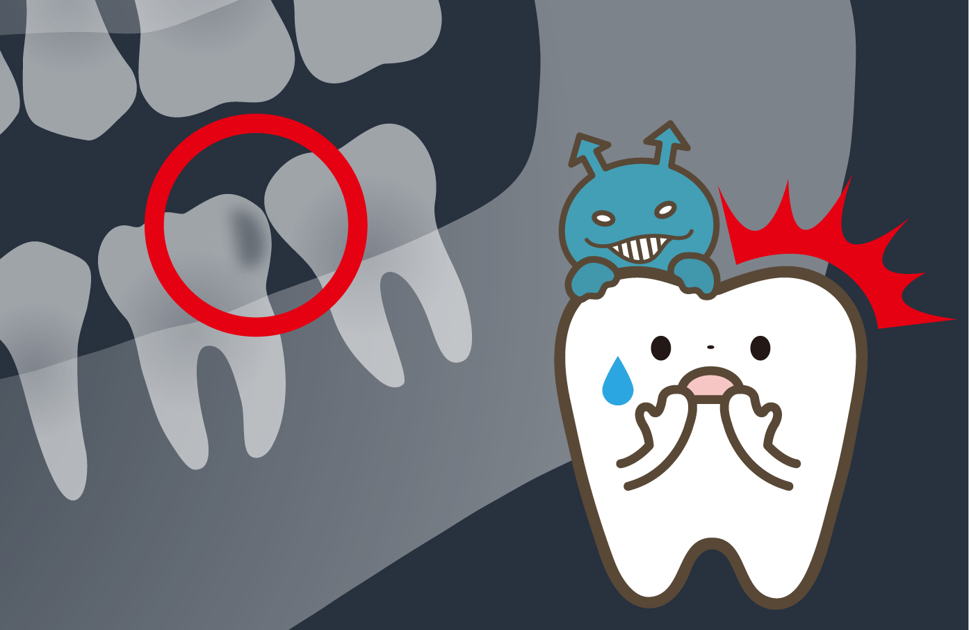 レントゲンでむし歯は黒く写る