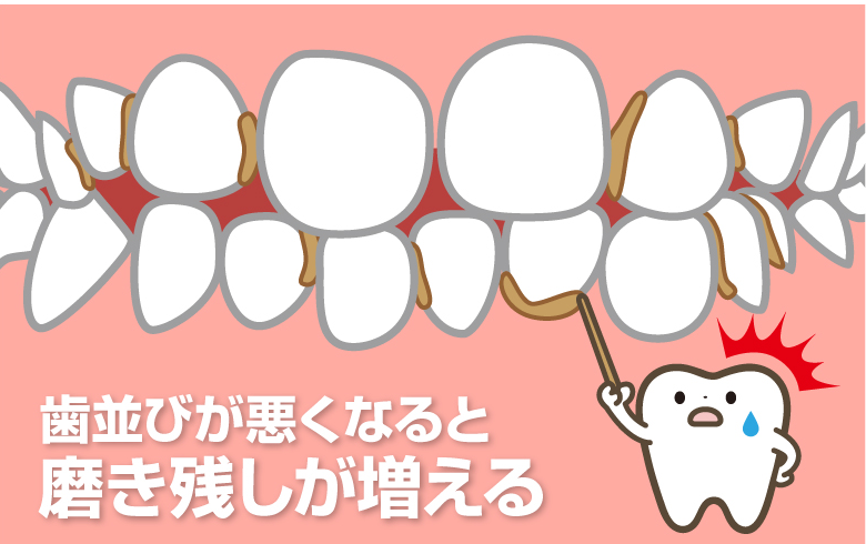 歯並びが悪いと磨き残しが増える