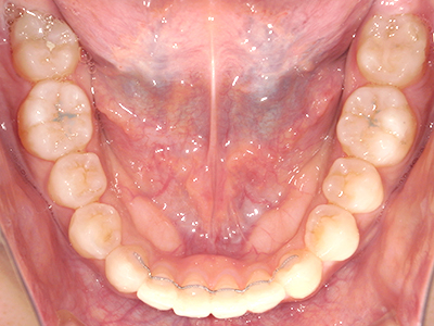 矯正治療後